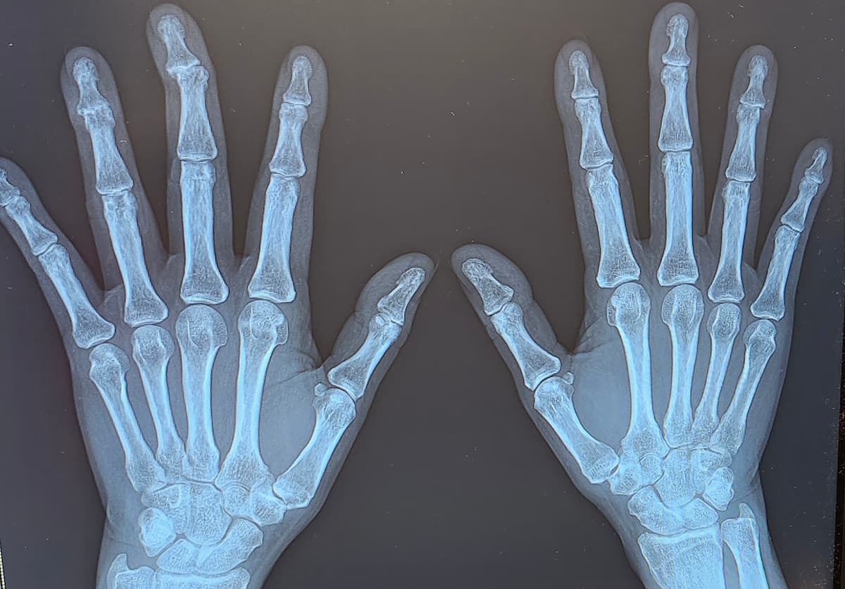 関節リウマチとヘバーデン結節の指を撮影したレントゲン(2026年4月)