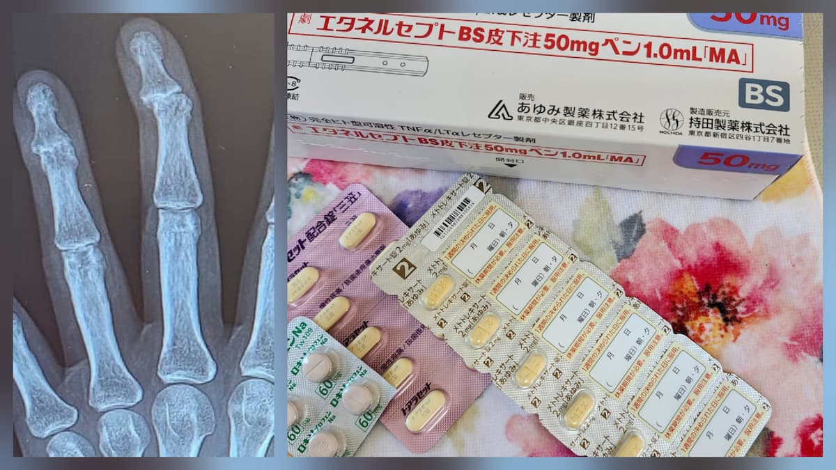 ヘバーデン結節で曲がった指のレントゲンと関節リウマチの薬