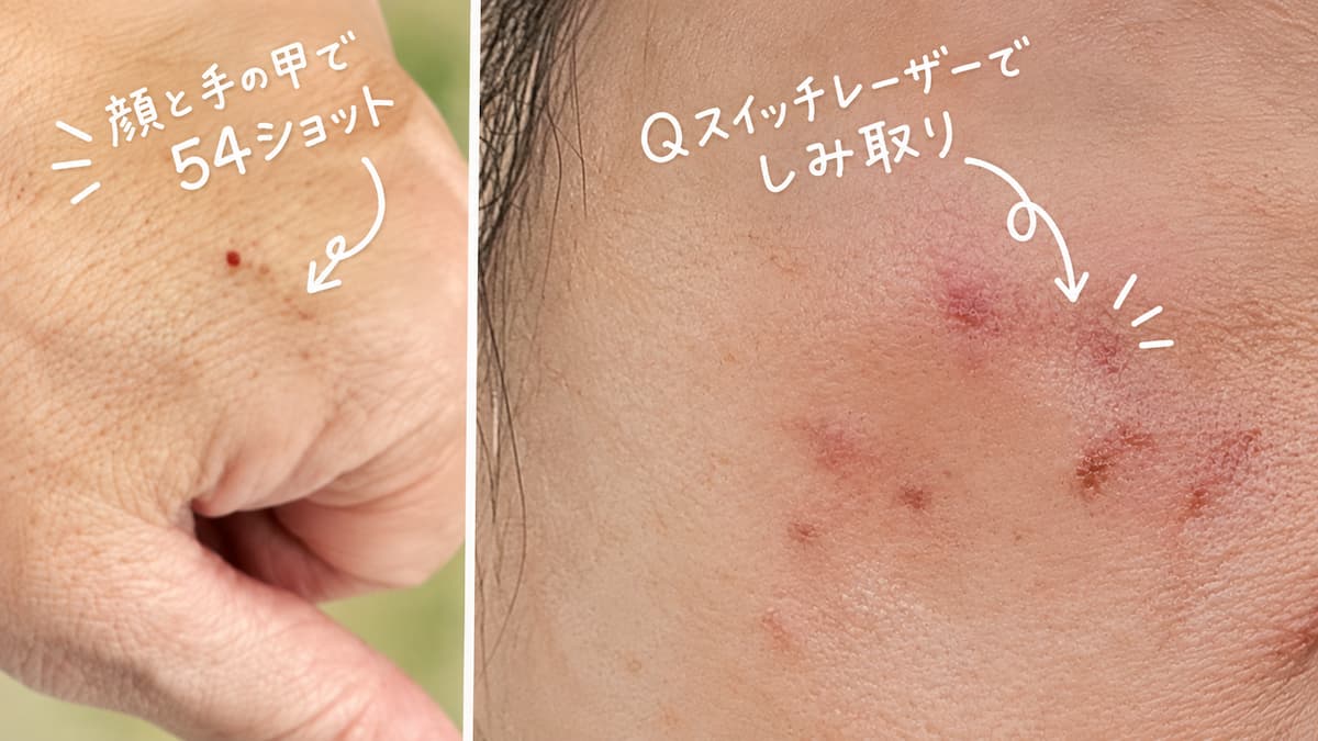 Qスイッチレーザーでしみ取り